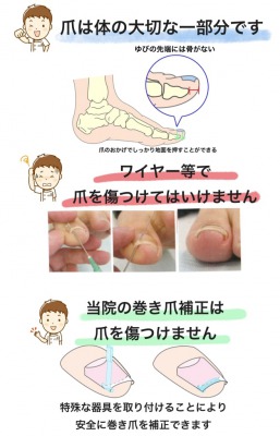 巻き爪矯正