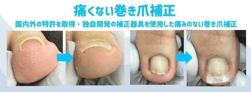 巻き爪改善