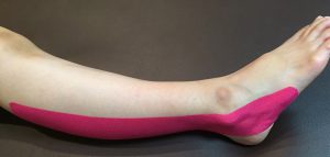 短腓骨筋腱炎テーピング