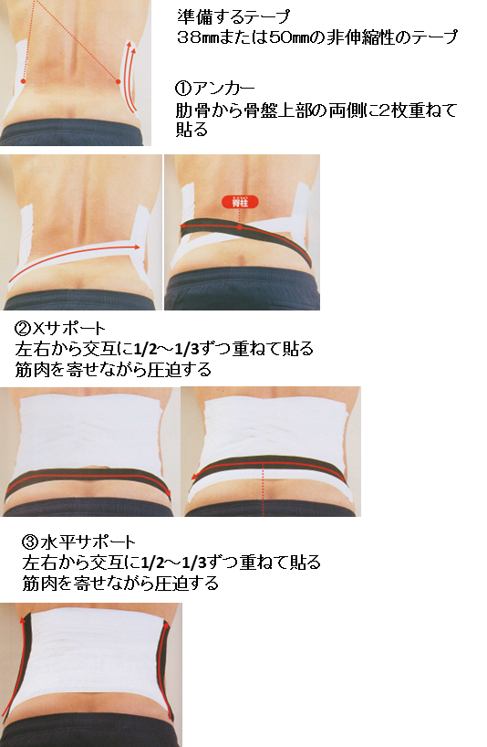 急性腰痛症(ぎっくり腰)のテーピング法