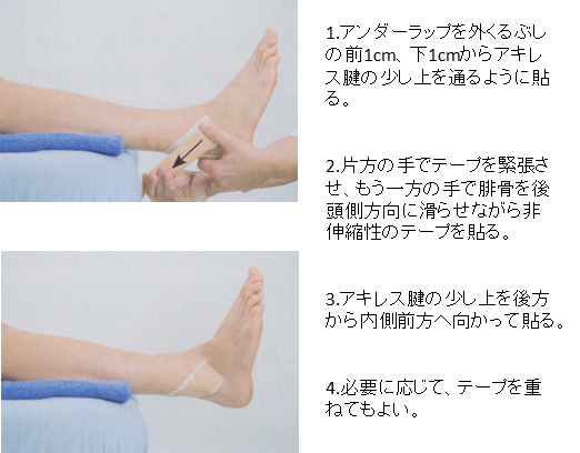 下脛腓関節の亜脱臼に対するテーピング