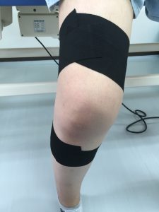 アルコット接骨院で行う前十字靭帯損傷に対するテーピング