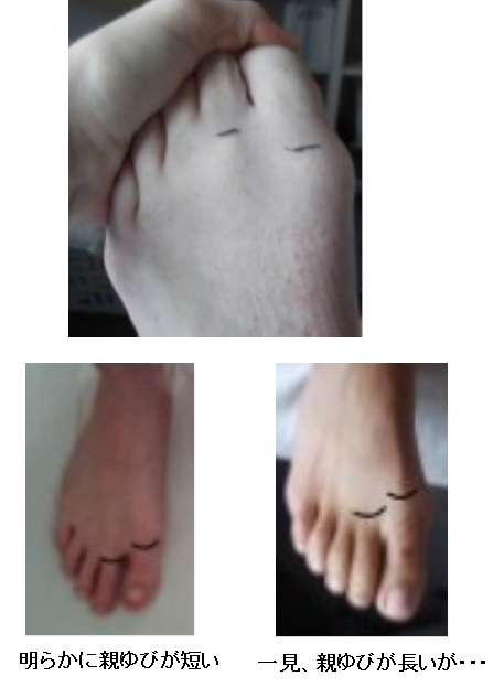 モートンフットの見つけ方