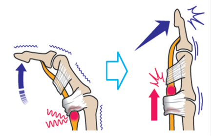ばね指・腱鞘炎の患者さまに対する筋膜リリース