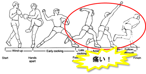 リトルリーガーズショルダーの痛みの出るフェーズ