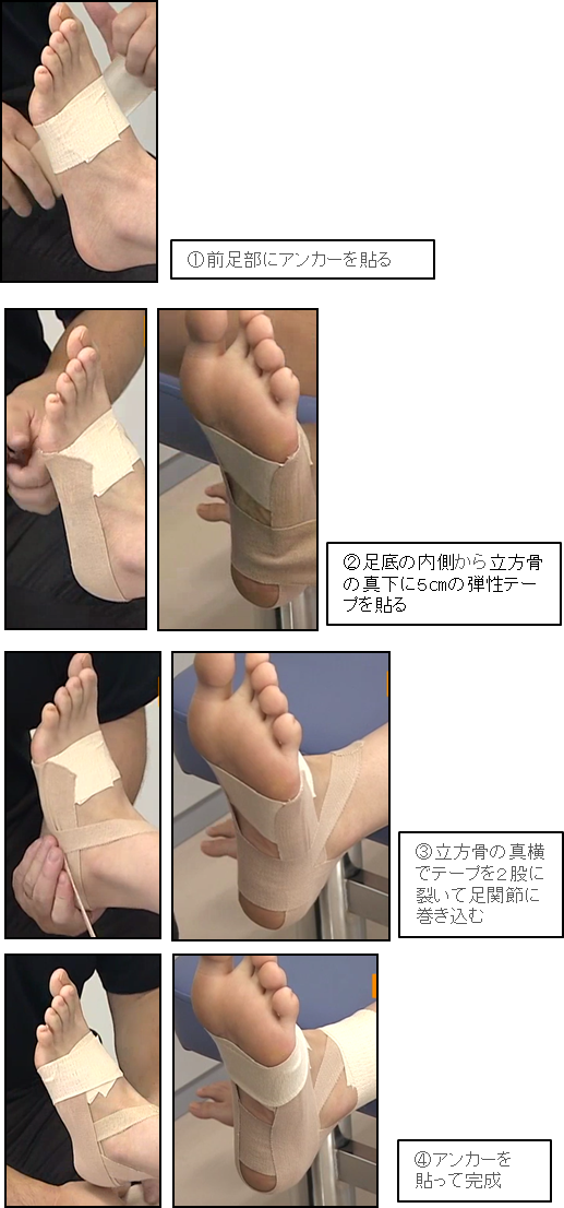 立方骨症候群に対するテーピング法