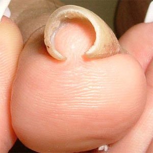 アルコット接骨院巻き爪弯曲爪