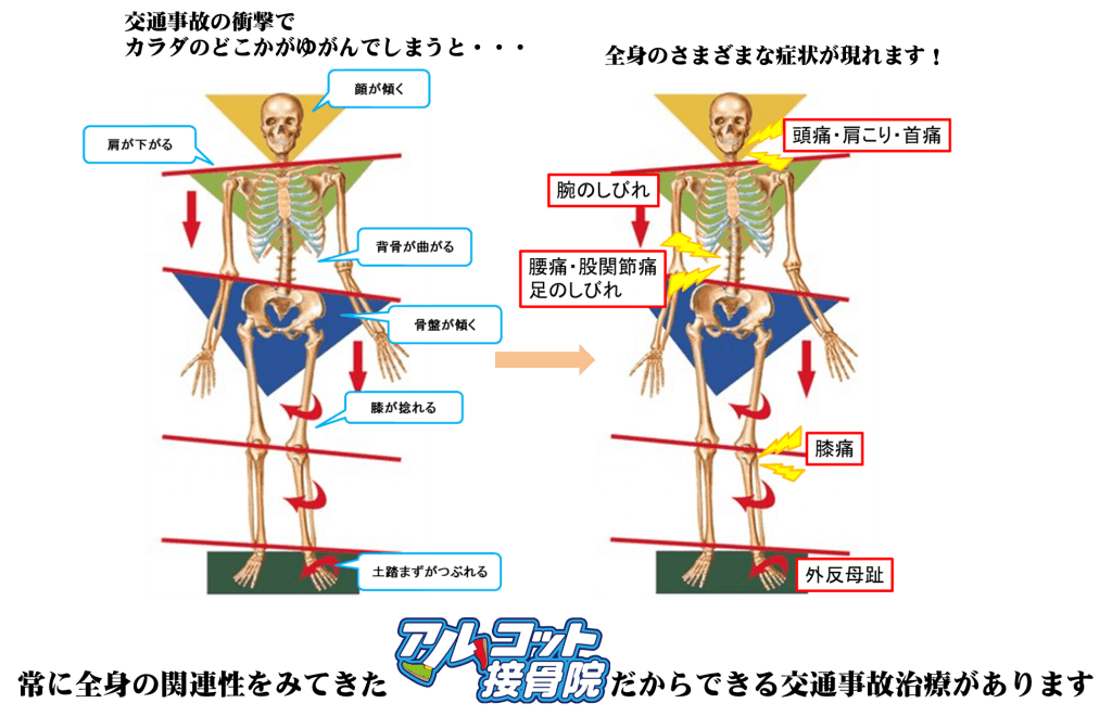 交通事故・むち打ちにより体がゆがむと・・・
