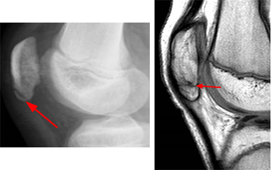 シンディングラーセンヨハンセン病 レントゲンとMRI