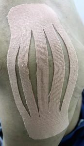 肩峰下インピンジメント症候群テーピング1