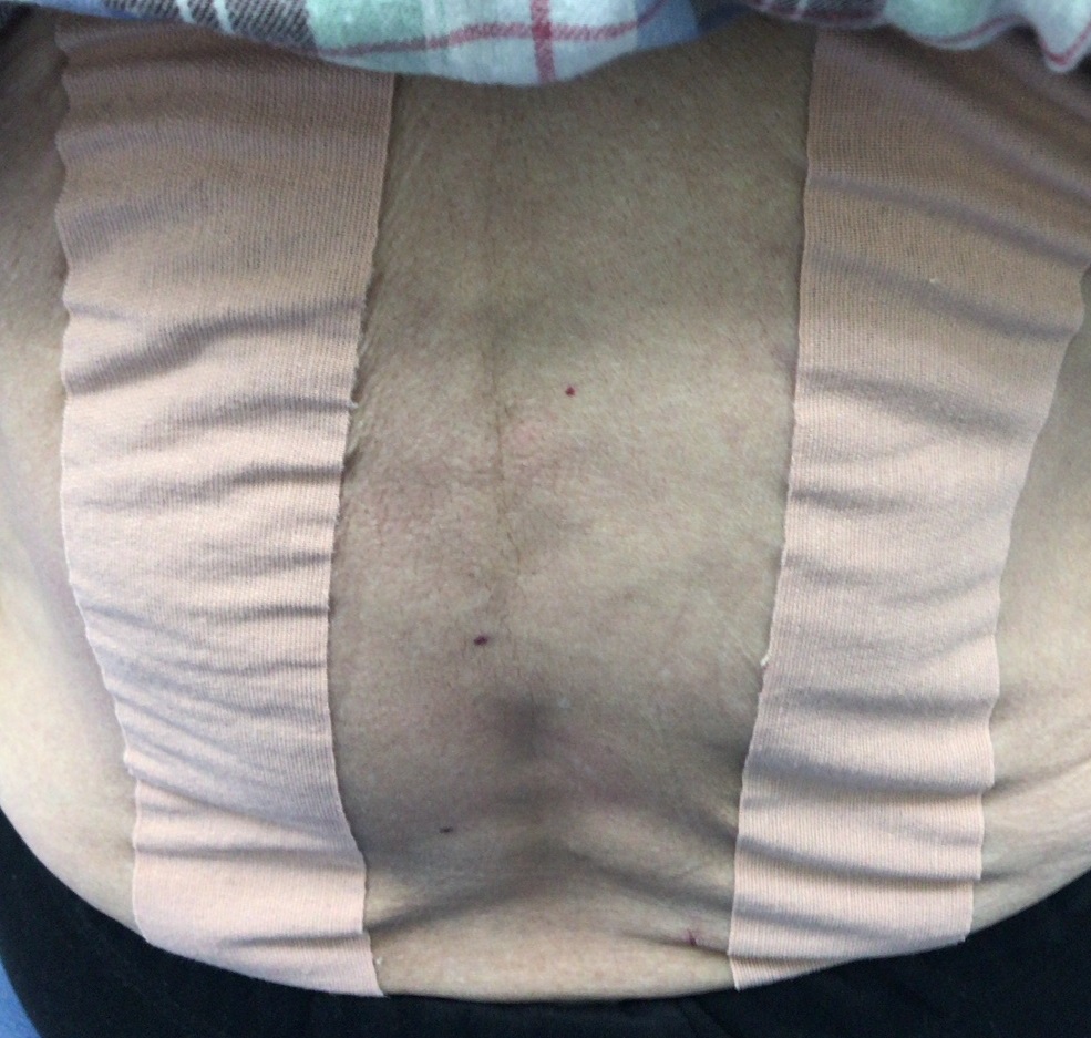 筋筋膜性腰痛症テーピング02