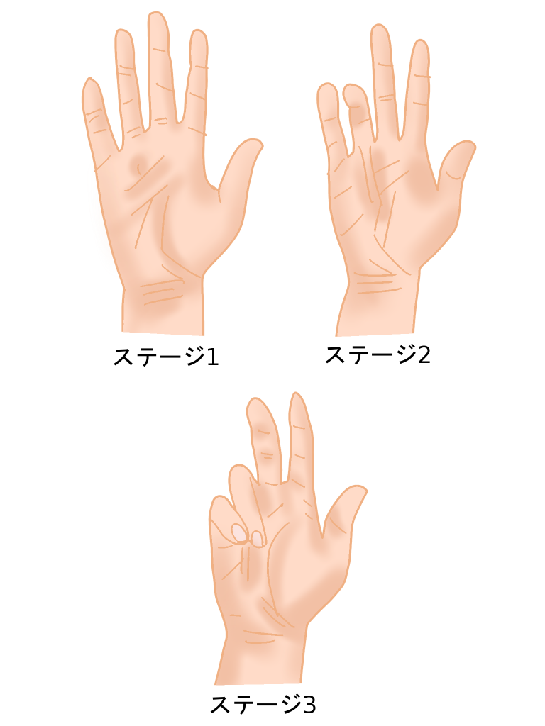 デュプトレン拘縮進行ステージ分類