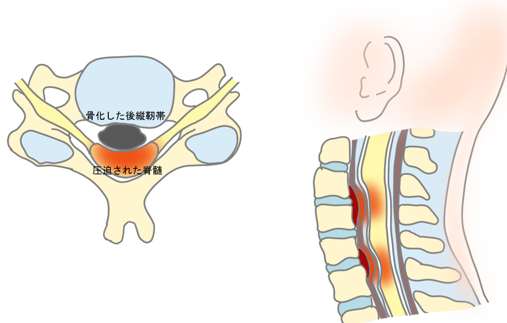 後縦靭帯骨化症とは