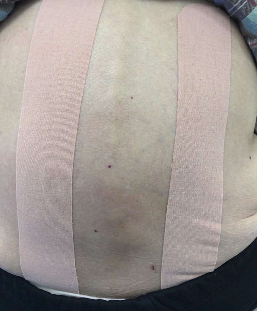 筋筋膜性腰痛症テーピング