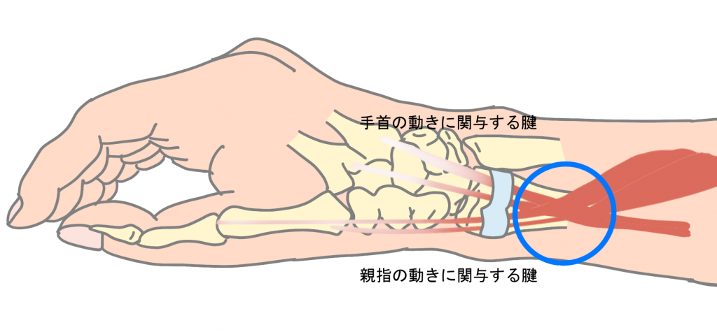 インターセクション症候群とは