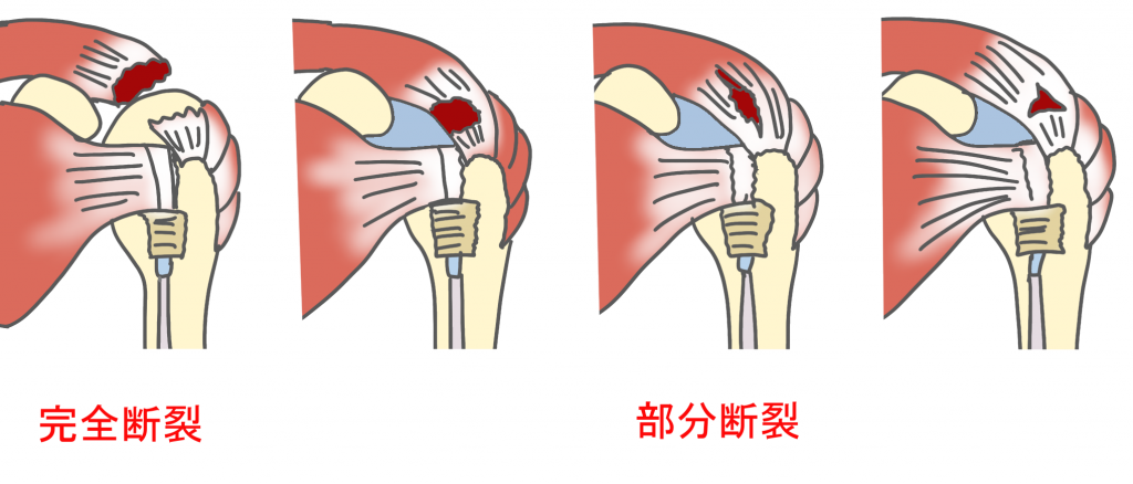 肩関節の術後の理学療法～ 腱板断裂／肩関節不安定症 ～ -