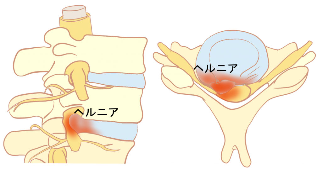 頚椎椎間板ヘルニアとは