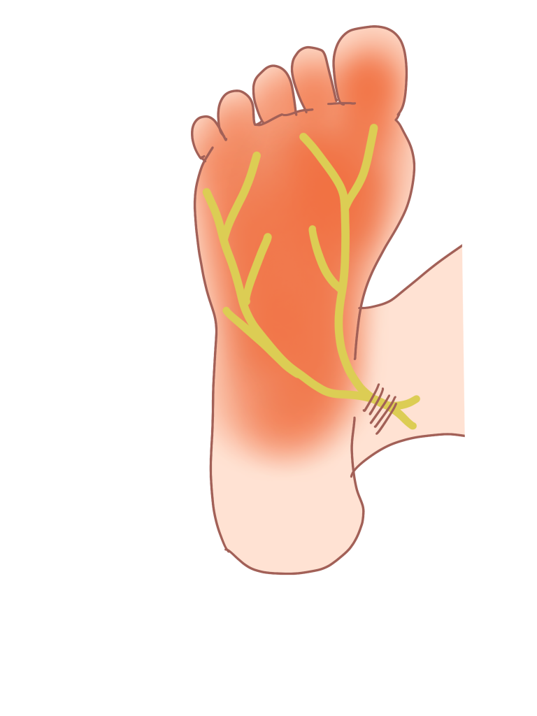足根管症候群の原因や治療法 金沢市アルコット接骨院 石川県金沢市 アルコット接骨院 スポーツ障害 巻き爪 インソール むち打ち