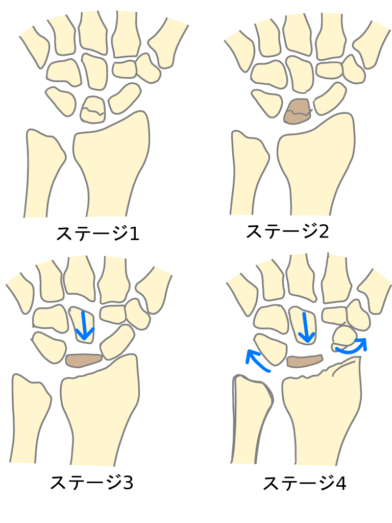 ベック 病 キーン