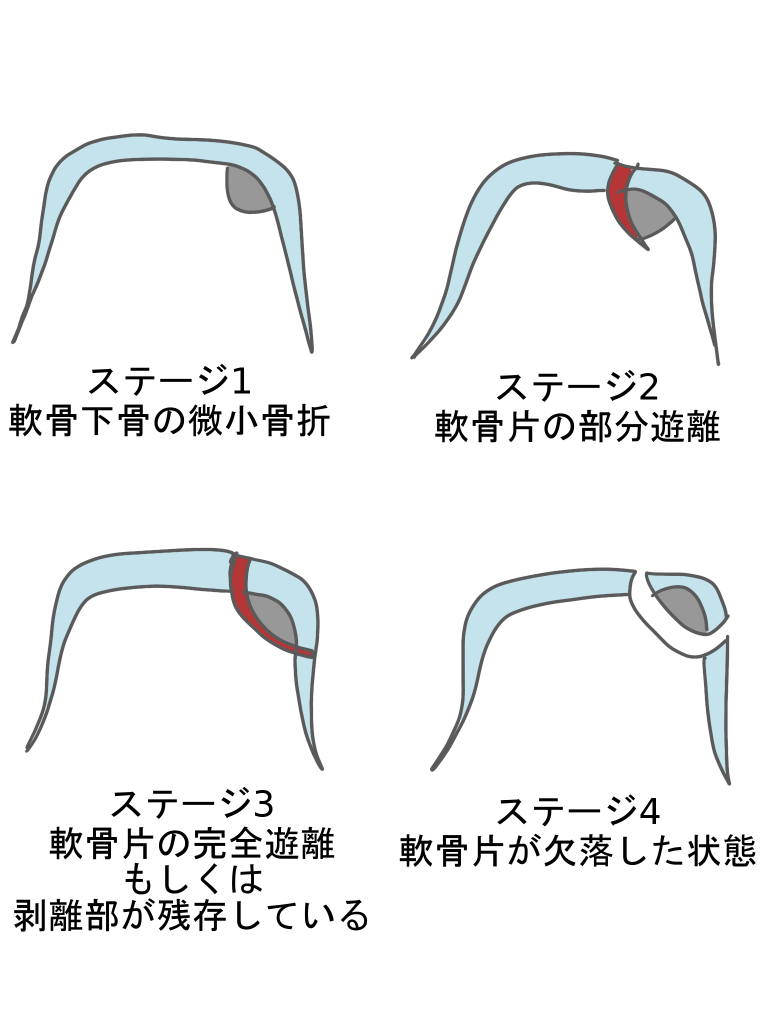 距骨骨軟骨損傷ステージ分類