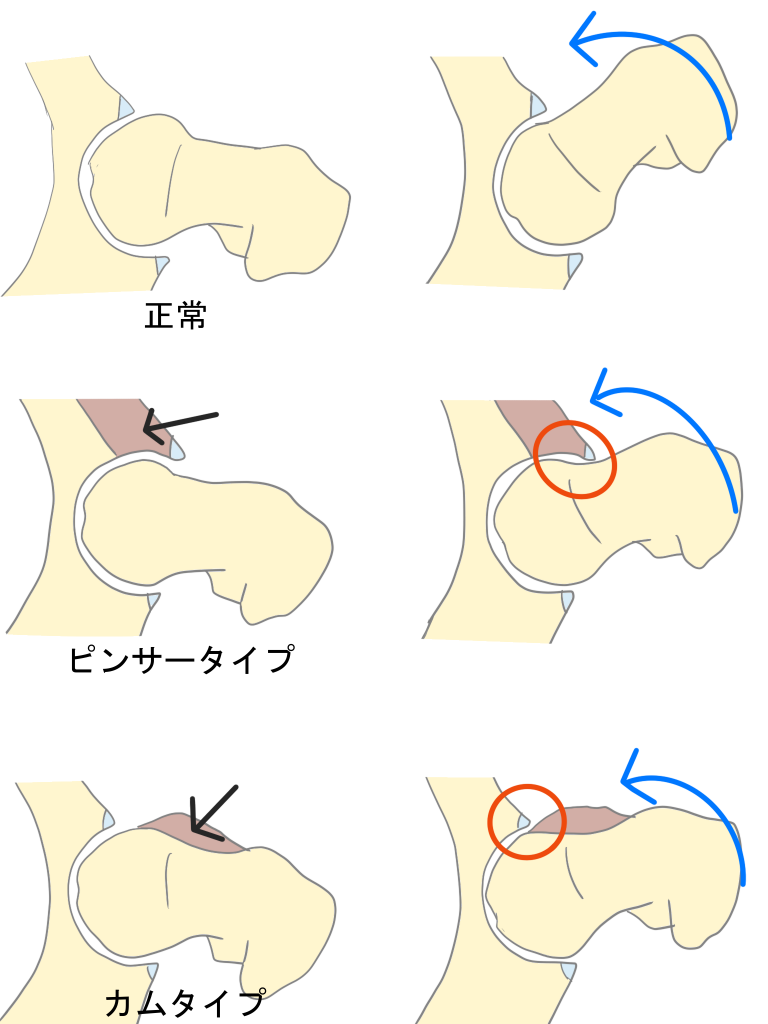 FAIの内旋制限
