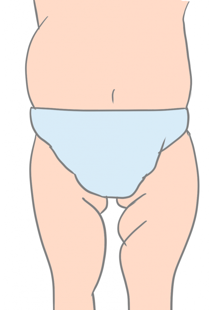 股関節炎皮膚の皺の数が違う