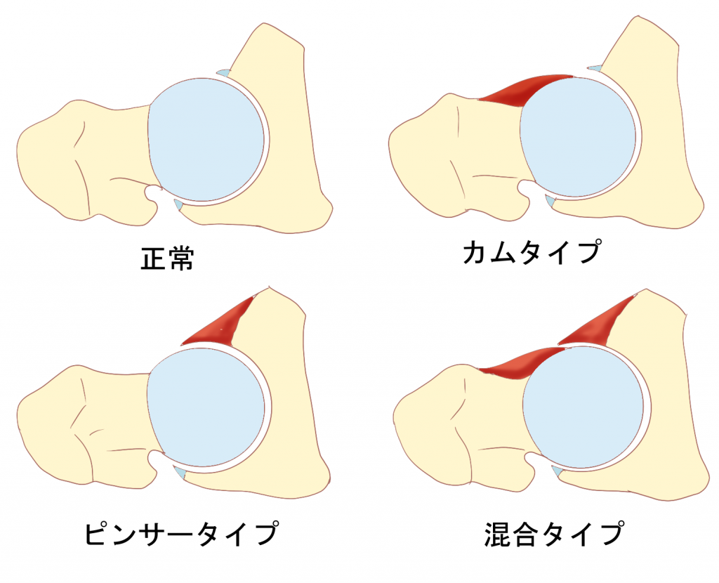 FAIのタイプカムタイプピンサータイプ