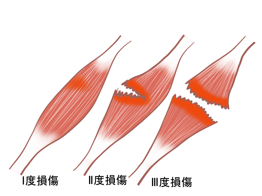 肉離れの分類
