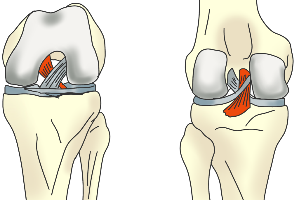 後十字靭帯損傷について 金沢市アルコット接骨院 金沢市アルコット接骨院 インソール工房併設