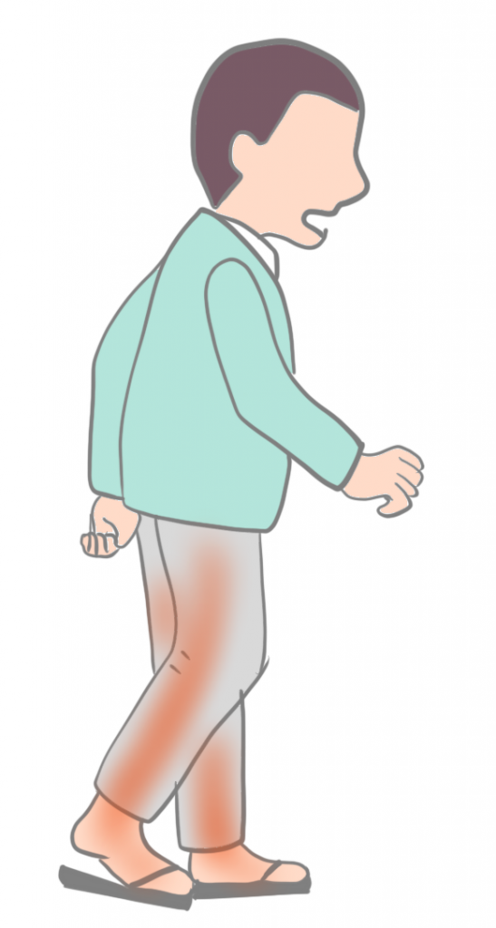 脊柱管狭窄症間欠性跛行画像