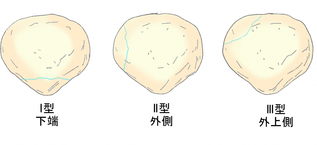 有痛性分裂膝蓋骨の分類