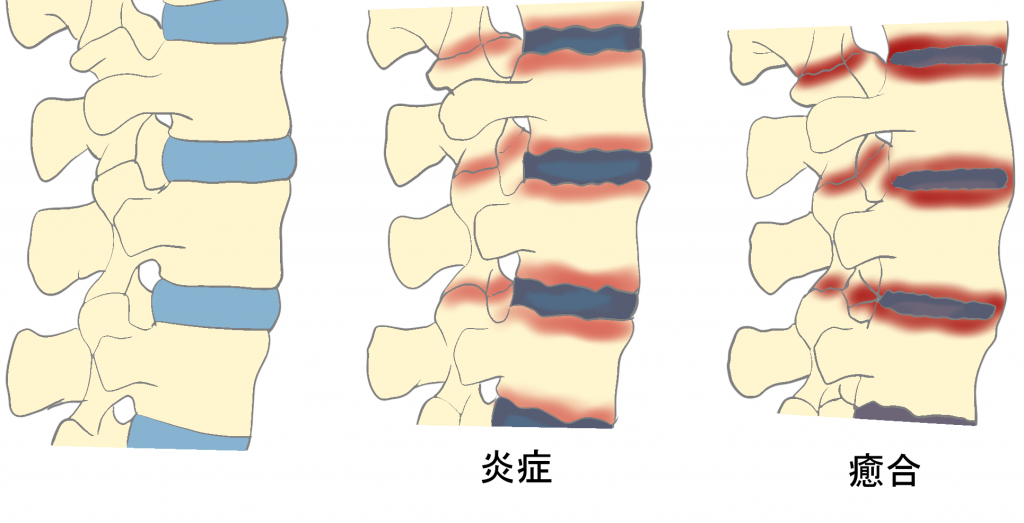 強直性脊椎炎脊椎の変性
