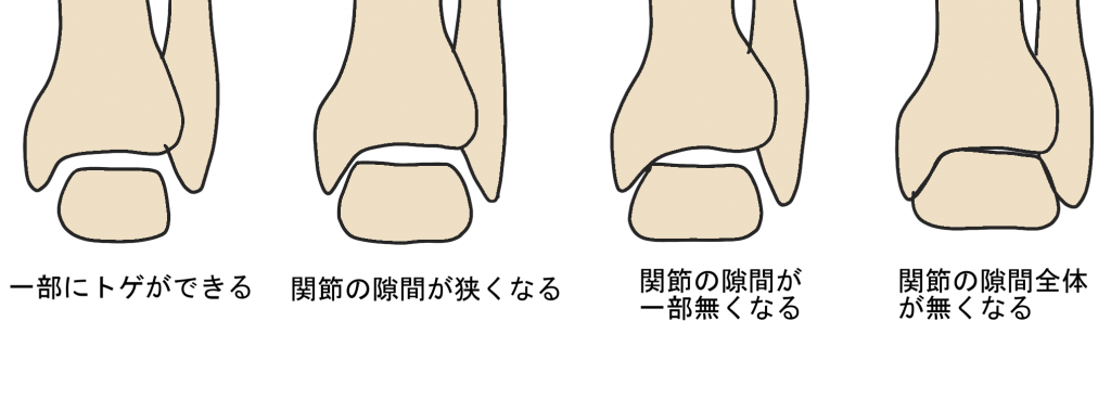 変形性足関節症の進行