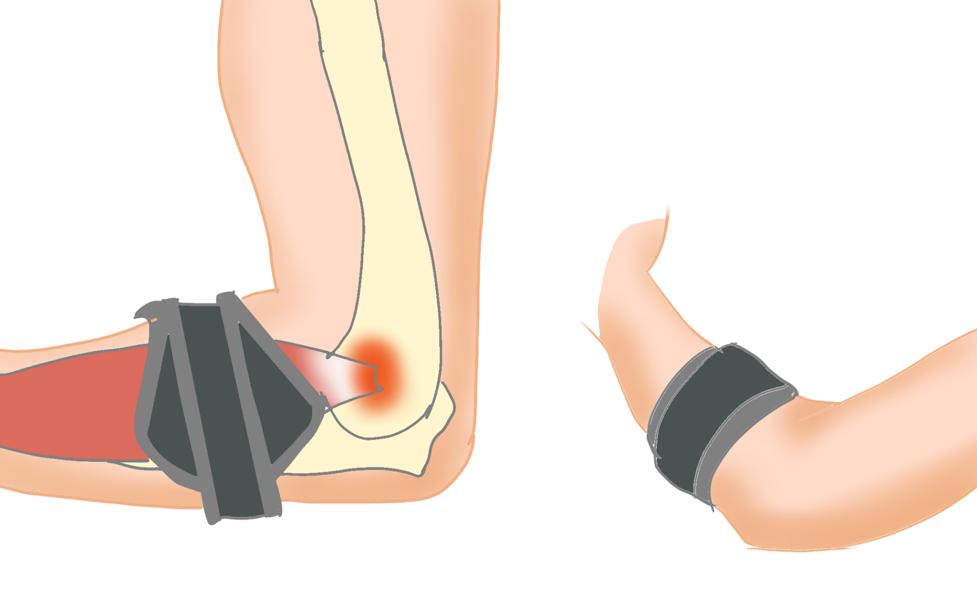 テニス肘手術の成功率と今後の見通し