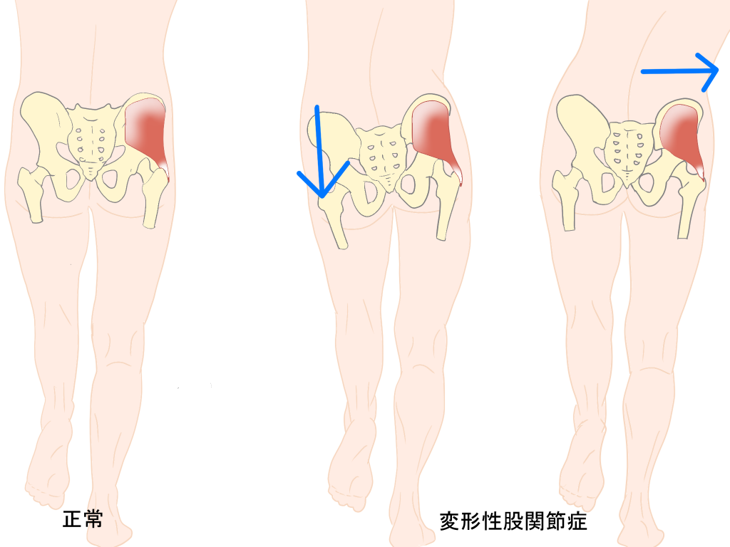 変形性股関節症の歩き方画像