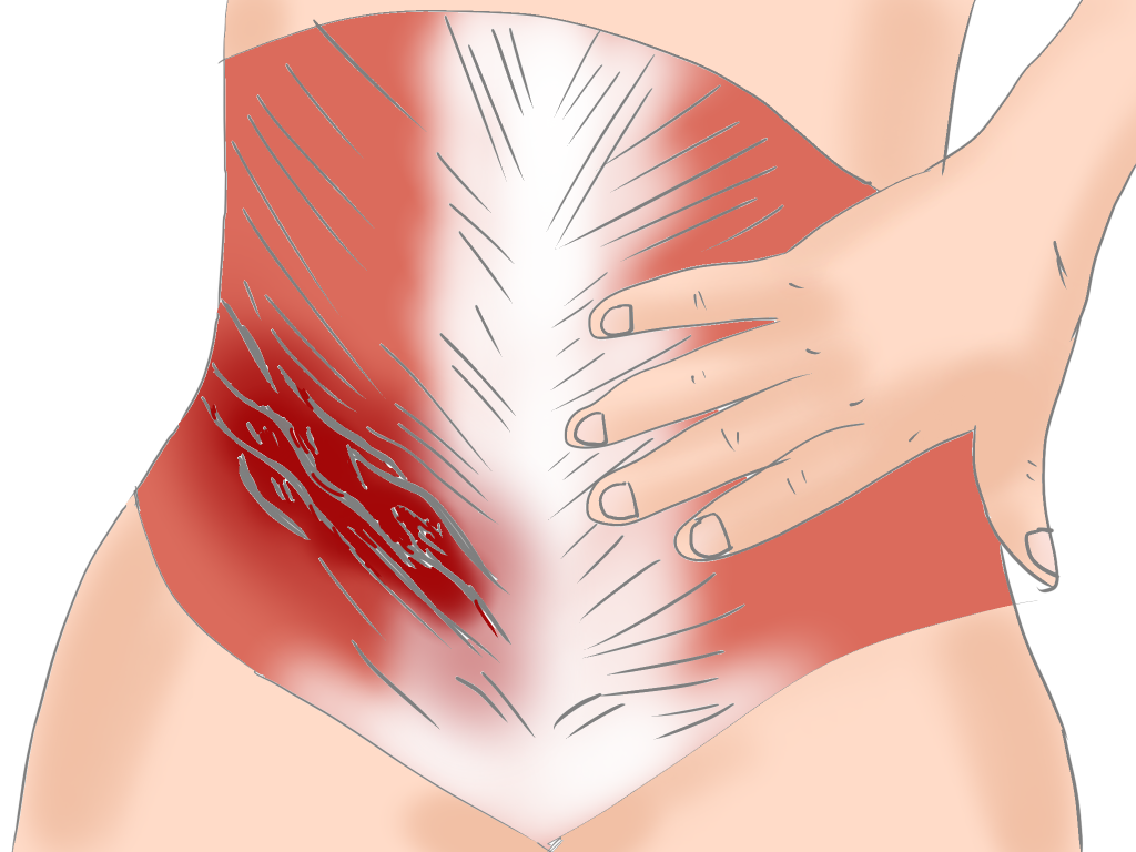 筋筋膜性腰痛症