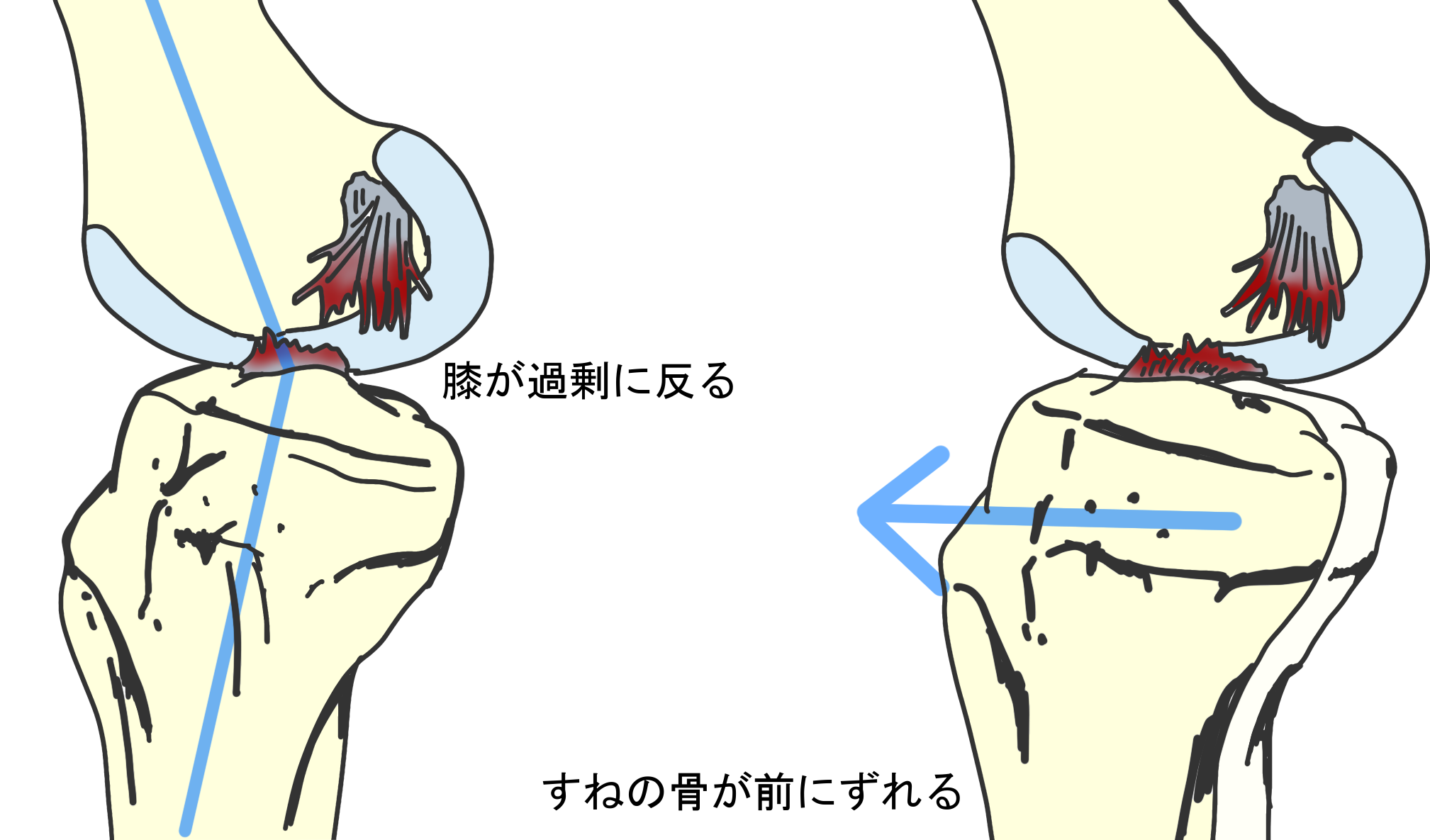 前十字靭帯損傷機能解剖 _ 前十字靭帯断裂 画像 – KOYZ
