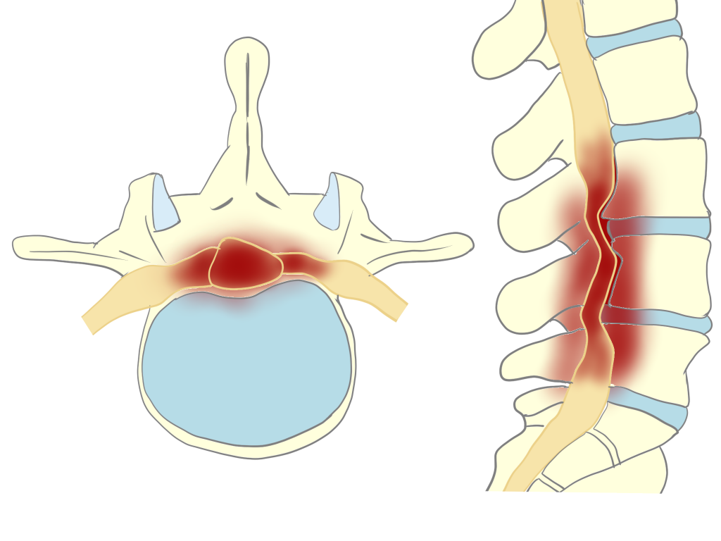 脊柱管狭窄症画像