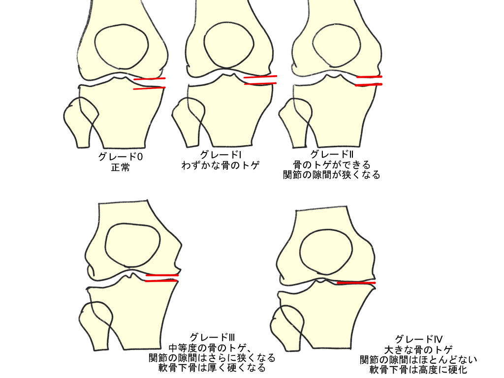 変形性膝関節症進行すると