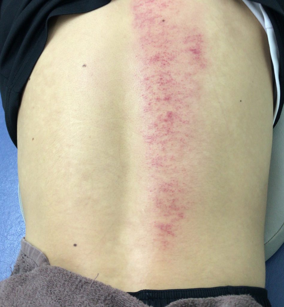 腰背部へのIASTM