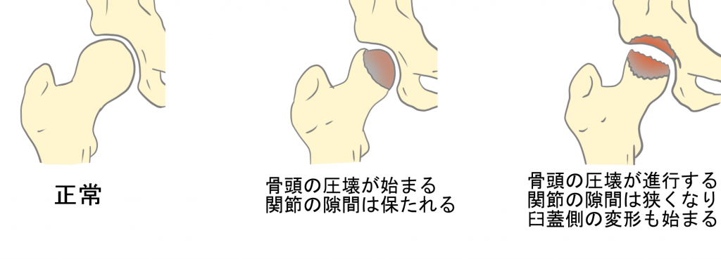 特発性大腿骨頭壊死症の進行
