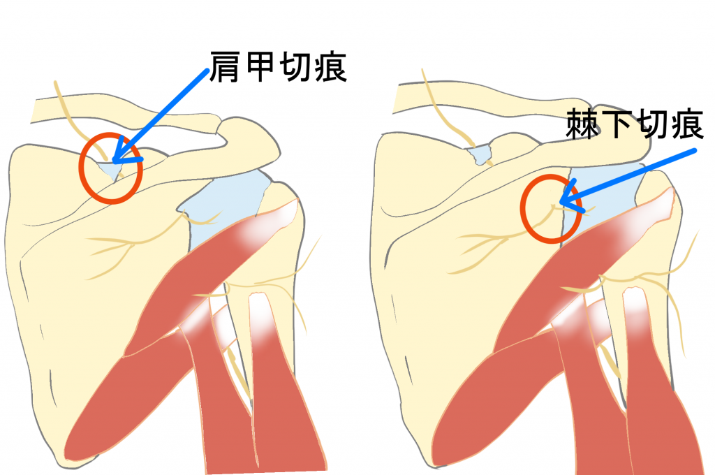 肩甲上神経圧迫