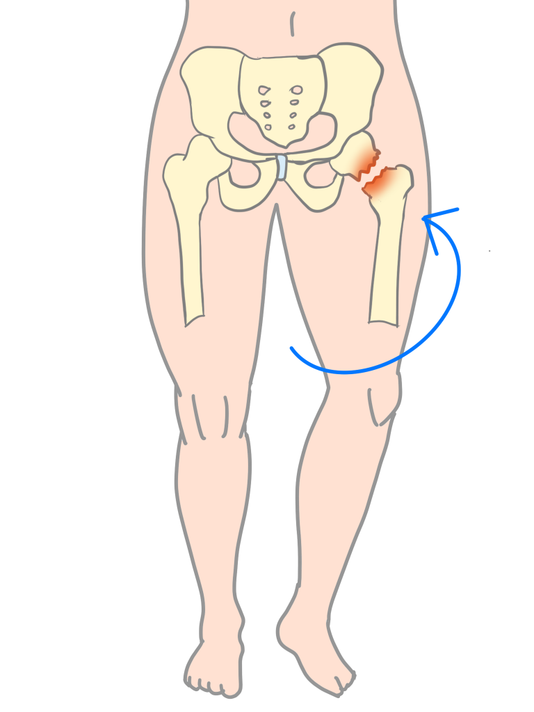 大腿骨頭すべり症足が外向きにねじれる