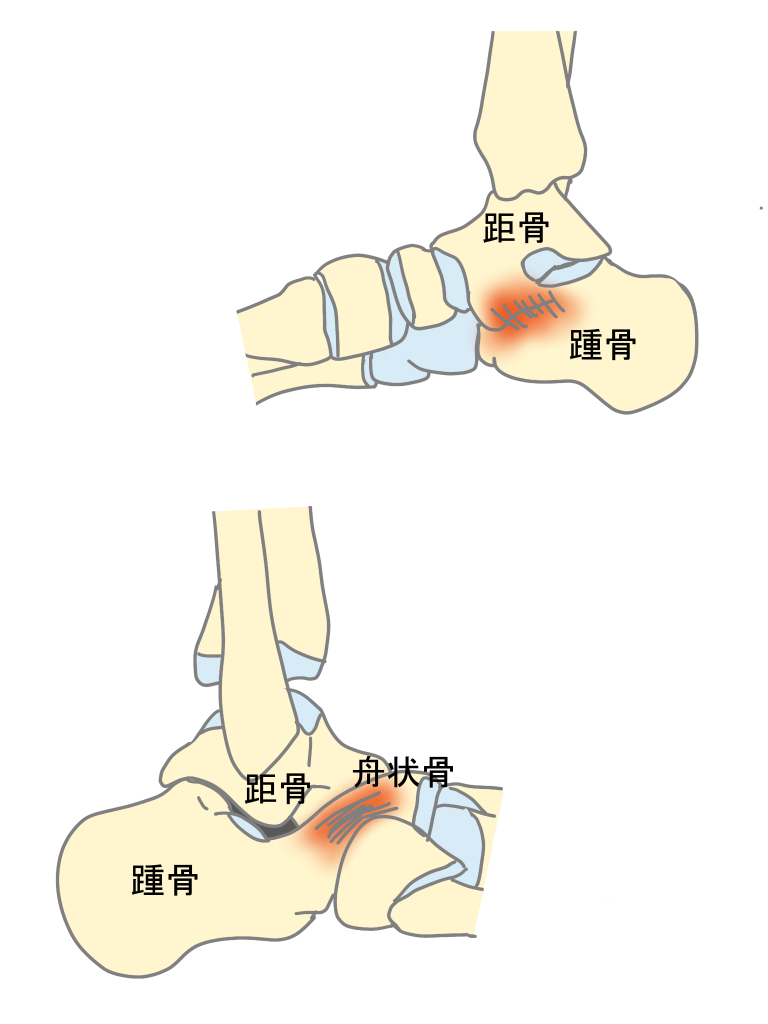 足根骨癒合症とは