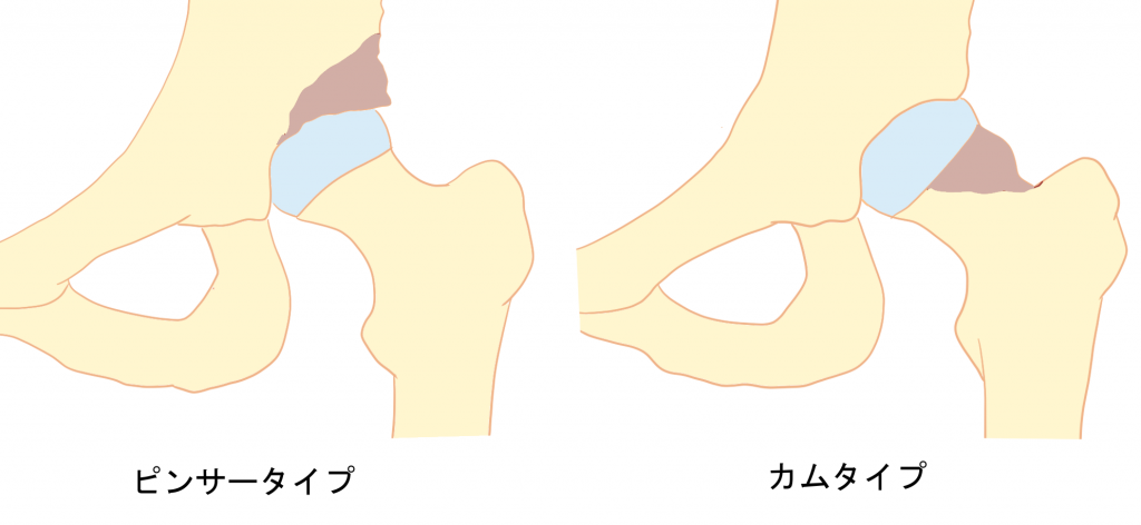 FAIのタイプカムタイプピンサータイプ