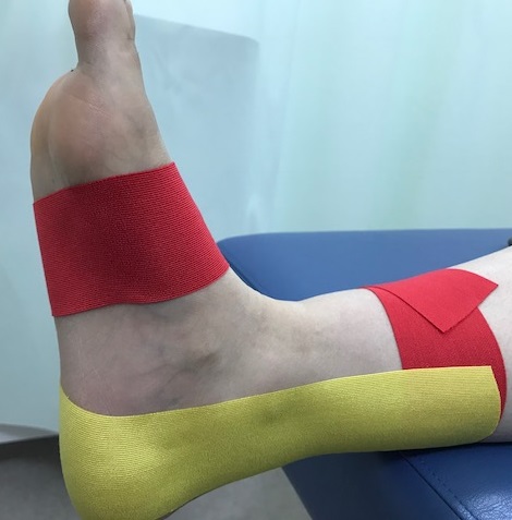 衝突性外骨腫に対するテーピング