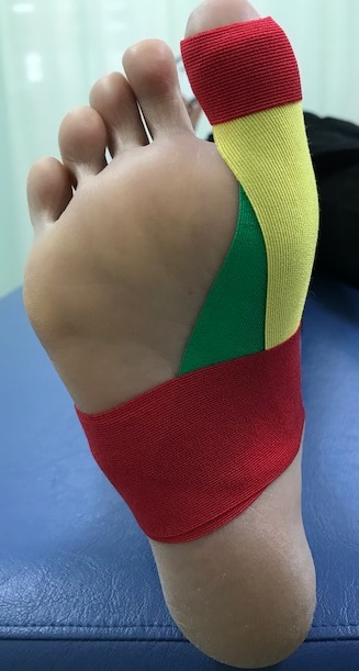 ターフトゥテーピング