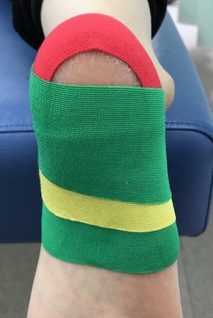 有痛性踵パッドテーピング色付き