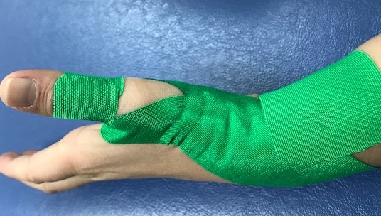 ドケルバン病テーピング