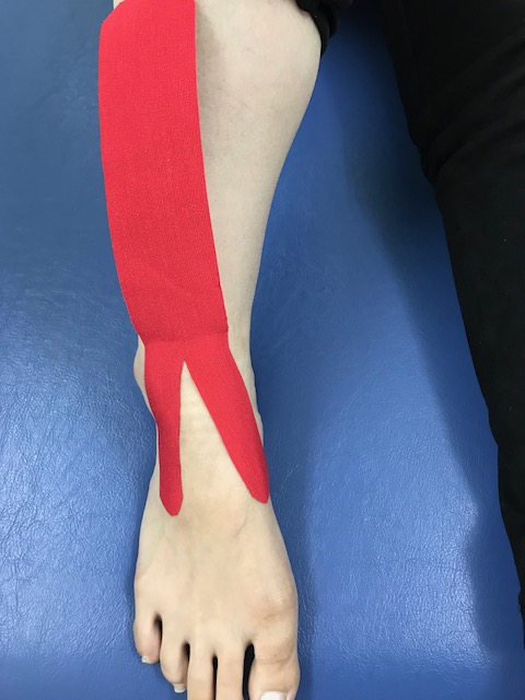 足関節後方インピンジメント症候群